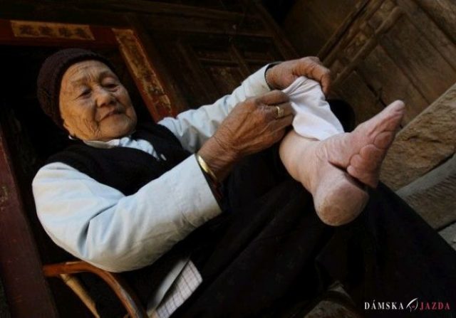 Číňanka patrí k posledným, ktorým pre krásu zlomili nohy