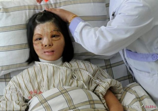 Tínedžerka bez tváre absolvovala úspešnú transplantáciu