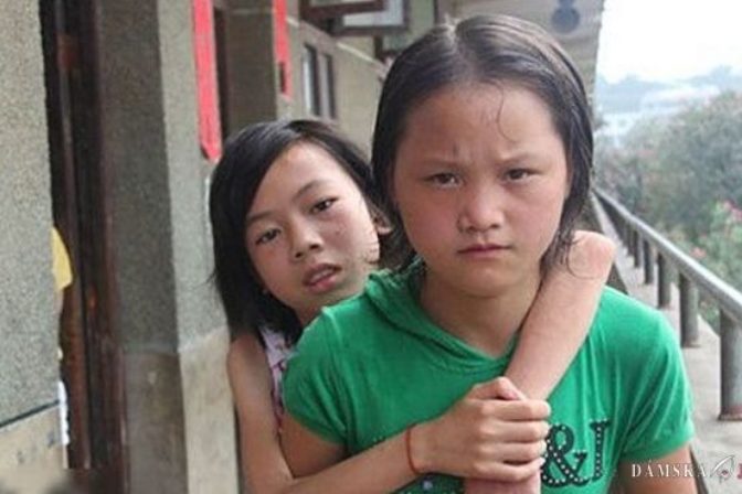 Obetavé dievča roky nosí chorú priateľku na chrbte do školy