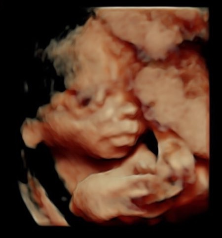 Chrissy ultrazvuk.jpg